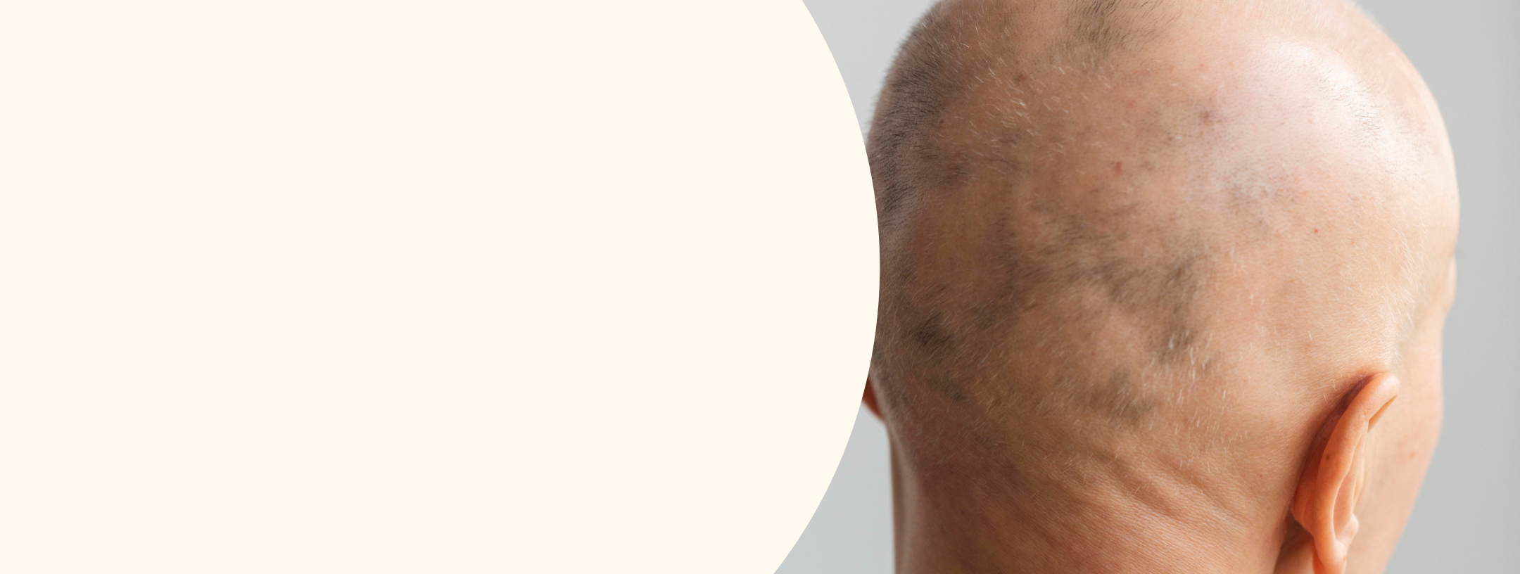HD-PRP Therapy