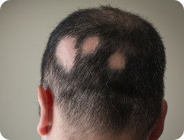 Alopecia Areata