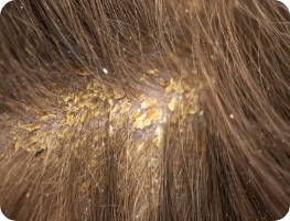 Alopecia Areata