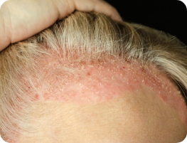 Alopecia Areata