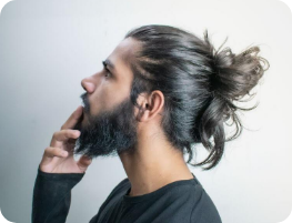 Alopecia Areata