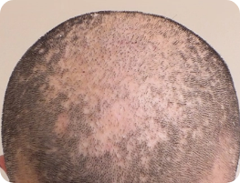 Alopecia Areata