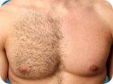delhi hair transplant